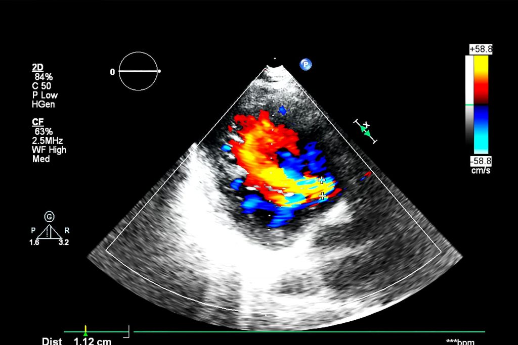 Ecocardiocolordoppler